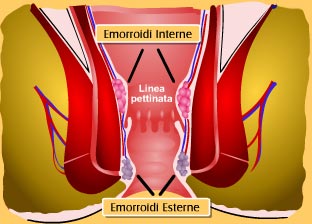 emorroidi