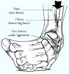 distorsione alla caviglia